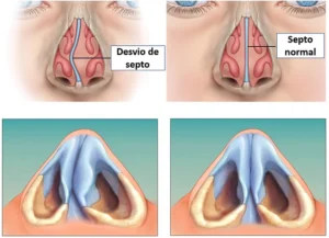 septoplastia diagrama
