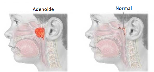 adenoide causando obstrução nasal