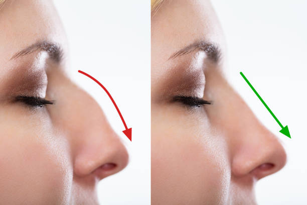 antes e depois da rinoplastia