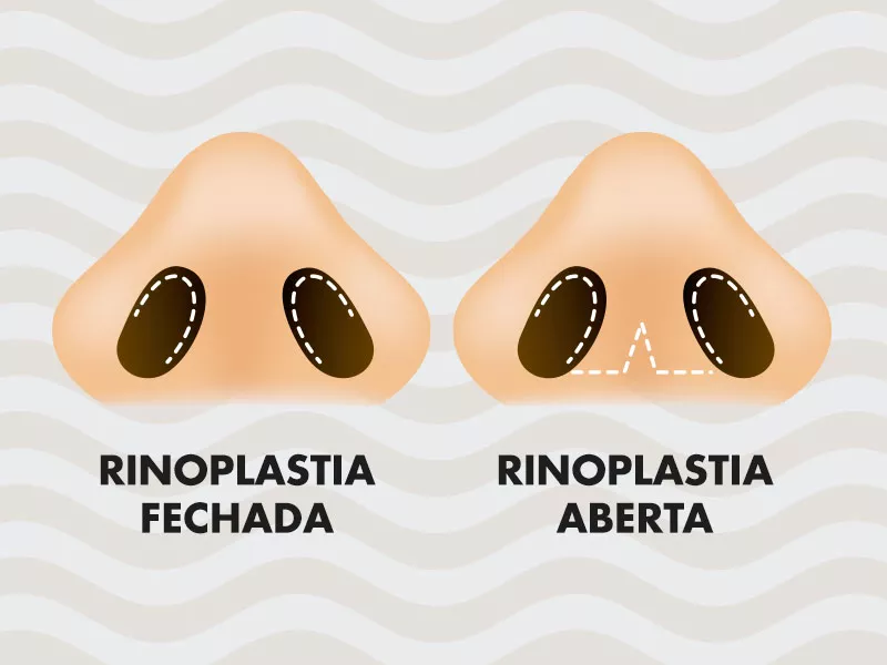 rinoplastia aberta e fechada